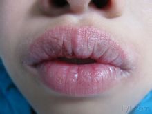 Cheilitt - Sider [1] - Verden leksikon kunnskap